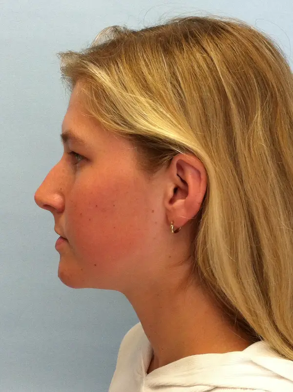 Rhinoplasty — before, left profile — Dr. Faramarz Shabdiz, MD. Individual results vary.