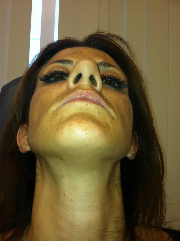 Rhinoplasty — before — Dr. Faramarz Shabdiz, MD. Individual results vary.