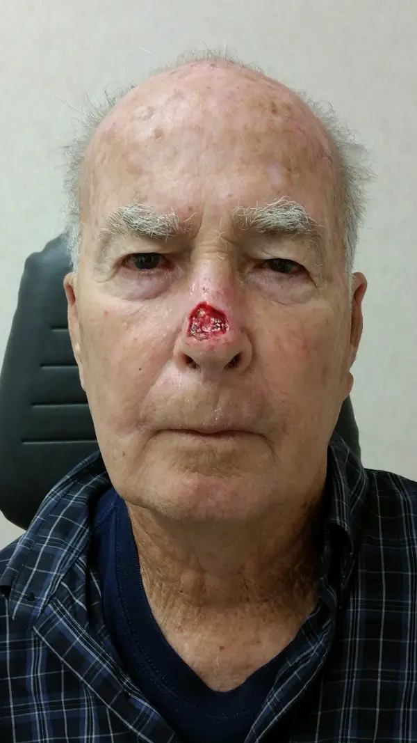 Facial reconstruction — before — Dr. Faramarz Shabdiz, MD. Individual results vary.