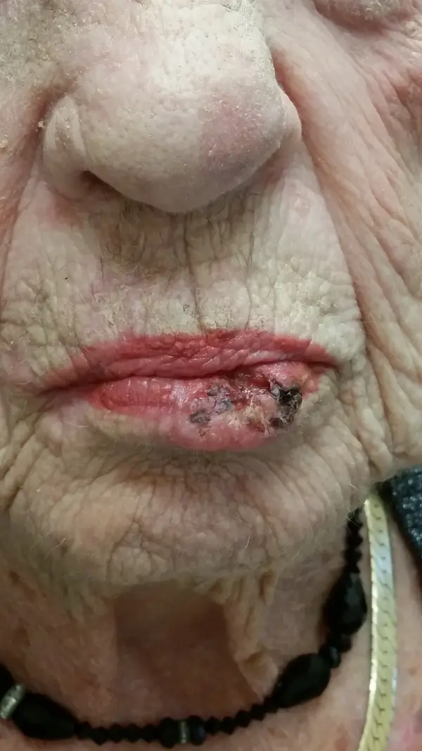 Facial reconstruction — before — Dr. Faramarz Shabdiz, MD. Individual results vary.