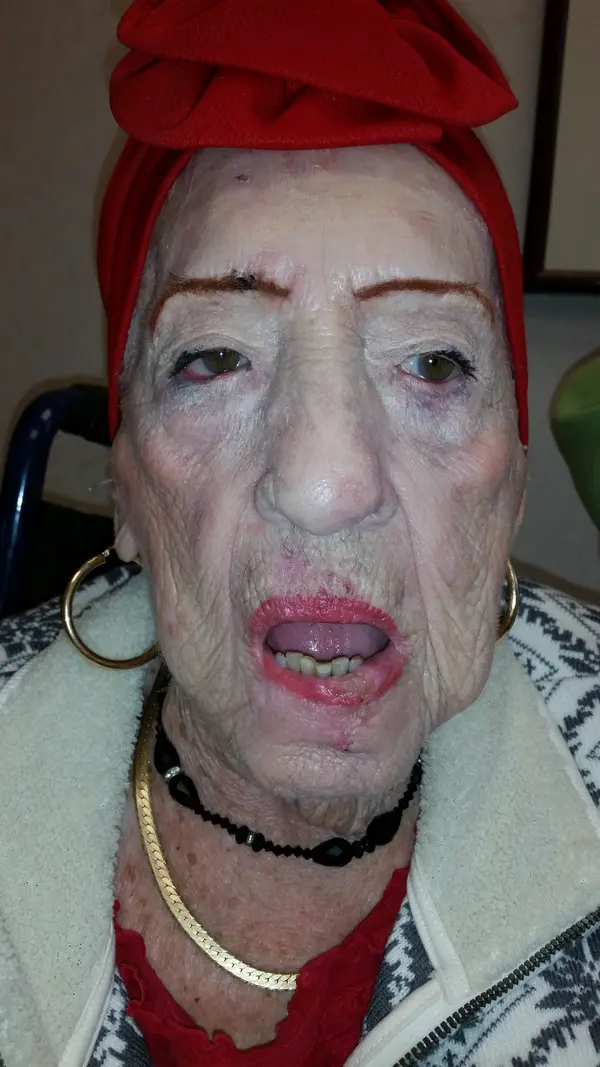 Facial reconstruction — after — Dr. Faramarz Shabdiz, MD. Individual results vary.