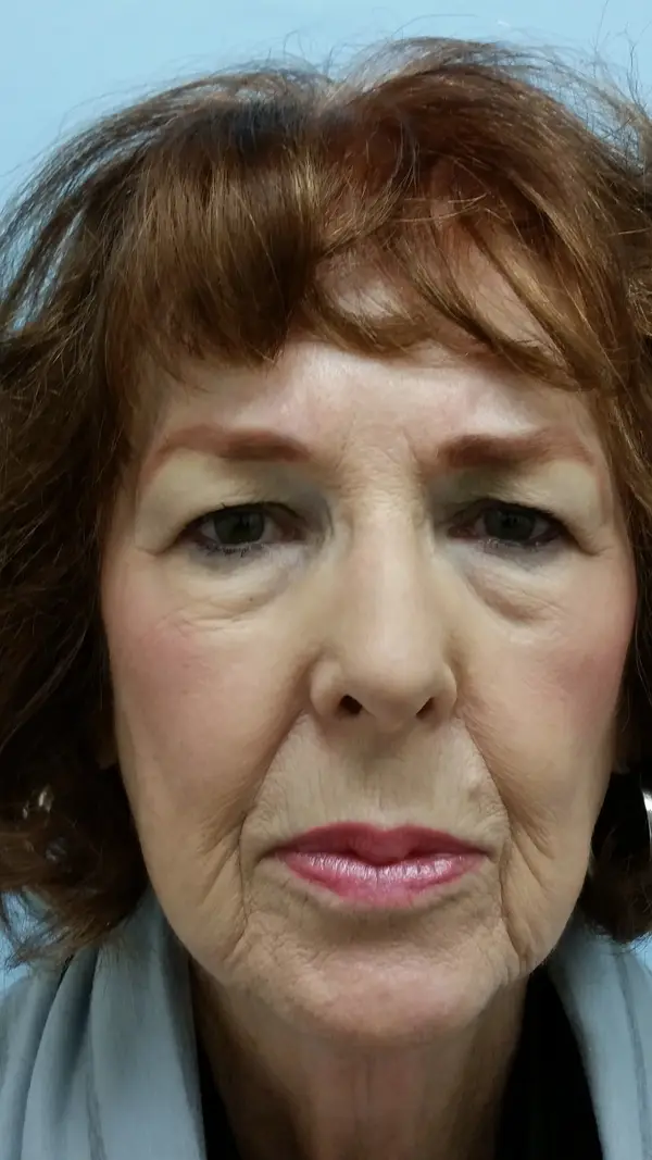 Rhinoplasty — before — Dr. Faramarz Shabdiz, MD. Individual results vary.