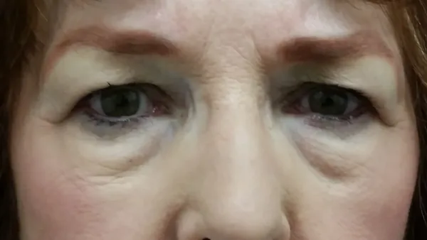 Additional Results — result photo, Dr. Faramarz Shabdiz, MD, Orange County, CA. Individual results vary.