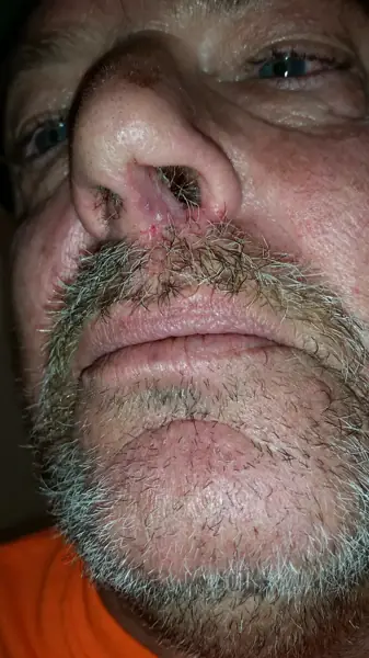 Facial reconstruction — after — Dr. Faramarz Shabdiz, MD. Individual results vary.