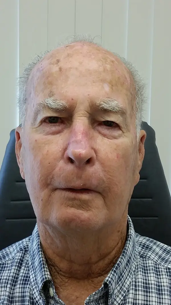 Facial reconstruction — after — Dr. Faramarz Shabdiz, MD. Individual results vary.