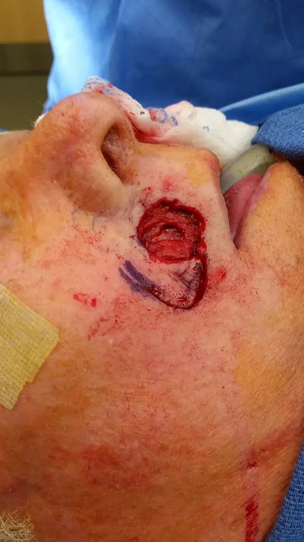 Facial reconstruction — before — Dr. Faramarz Shabdiz, MD. Individual results vary.