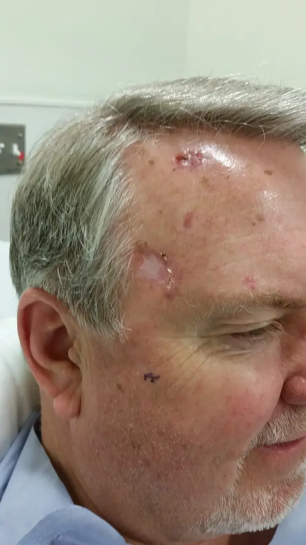 Facial reconstruction — before — Dr. Faramarz Shabdiz, MD. Individual results vary.