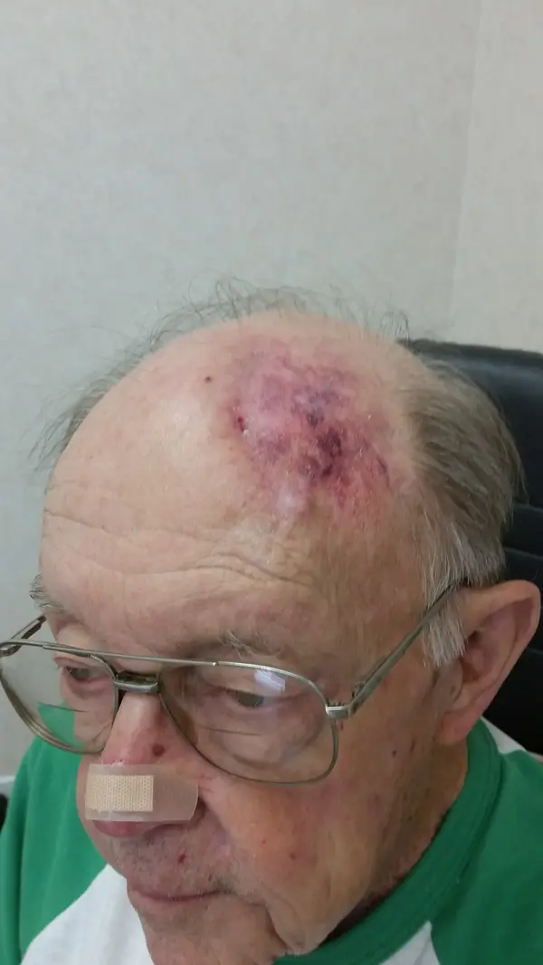 Facial reconstruction — before — Dr. Faramarz Shabdiz, MD. Individual results vary.