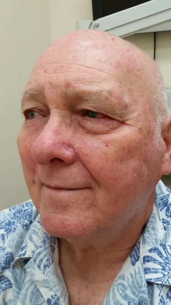 Facial reconstruction — after — Dr. Faramarz Shabdiz, MD. Individual results vary.