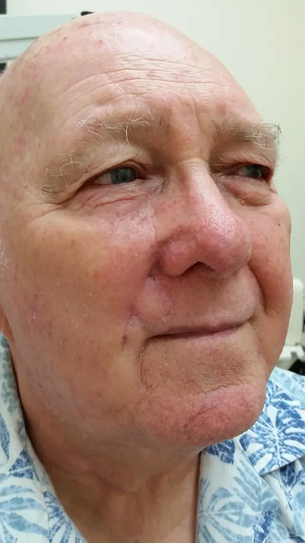 Facial reconstruction — after — Dr. Faramarz Shabdiz, MD. Individual results vary.