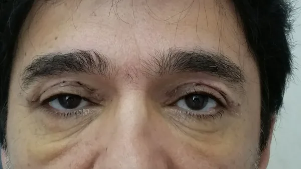 Additional Results — result photo, Dr. Faramarz Shabdiz, MD, Orange County, CA. Individual results vary.