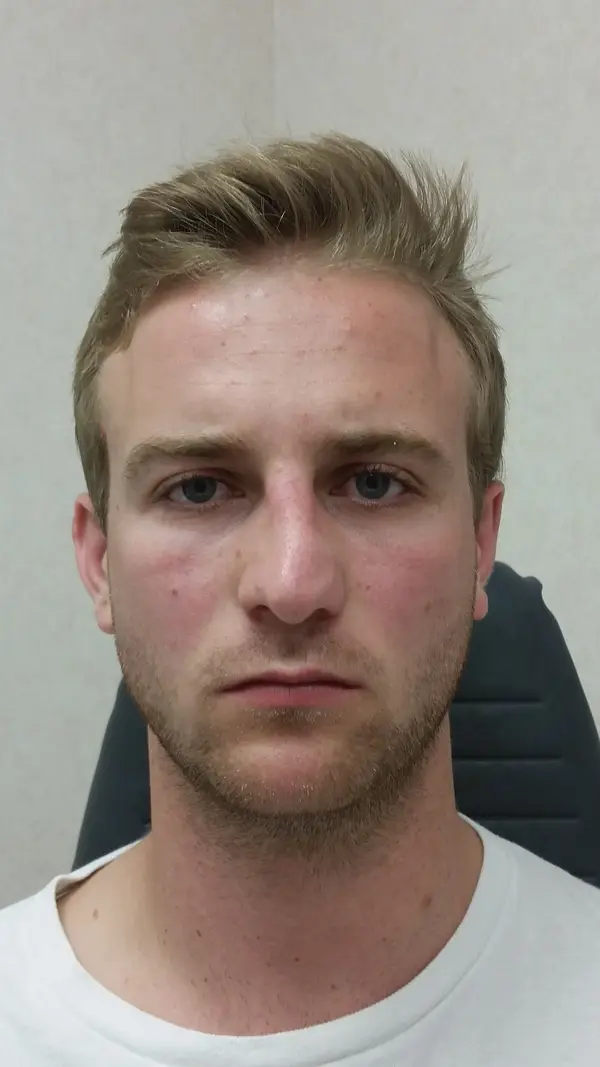 Rhinoplasty — result photo, Dr. Faramarz Shabdiz, MD, Orange County, CA. Individual results vary.