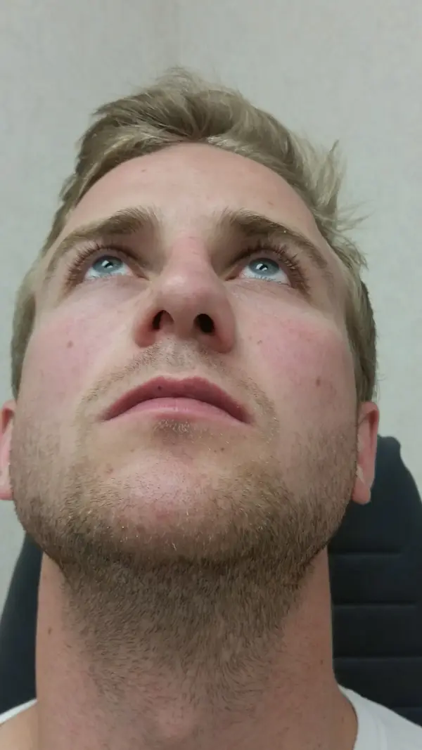 Rhinoplasty — result photo, Dr. Faramarz Shabdiz, MD, Orange County, CA. Individual results vary.