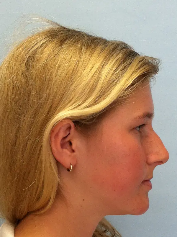 Rhinoplasty — result photo, Dr. Faramarz Shabdiz, MD, Orange County, CA. Individual results vary.