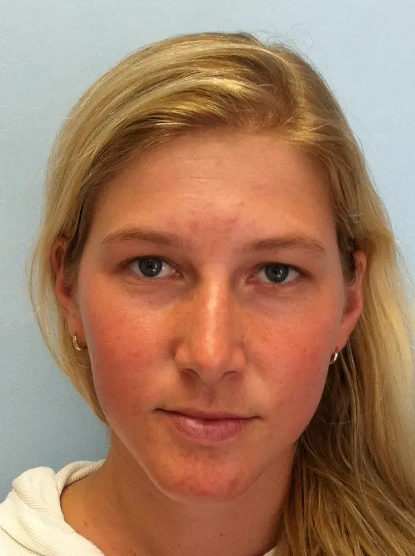 Rhinoplasty — before, front — Dr. Faramarz Shabdiz, MD. Individual results vary.