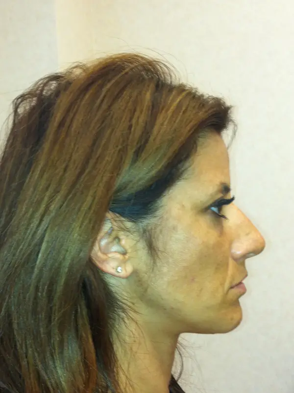 Rhinoplasty — before — Dr. Faramarz Shabdiz, MD. Individual results vary.