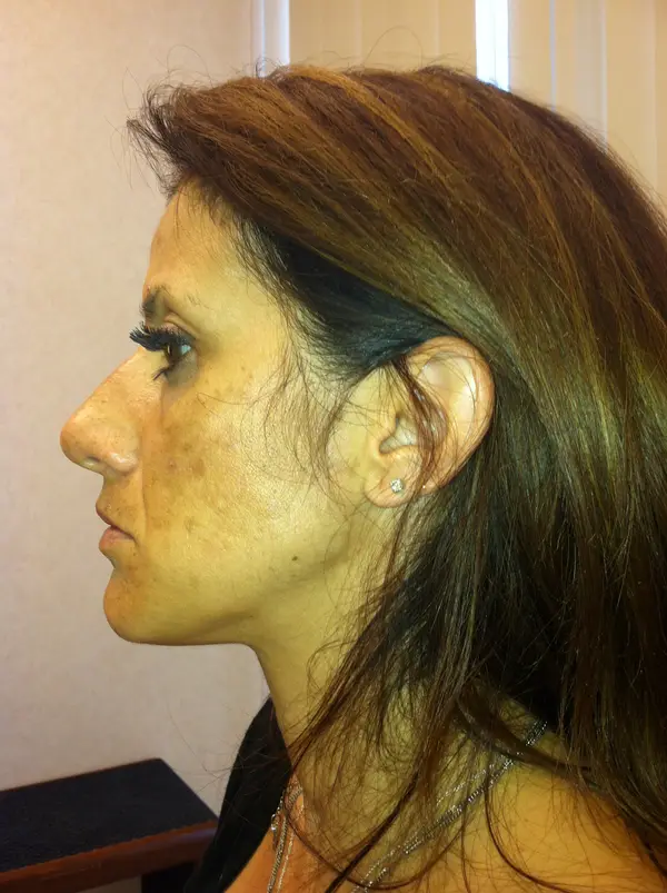 Rhinoplasty — before — Dr. Faramarz Shabdiz, MD. Individual results vary.