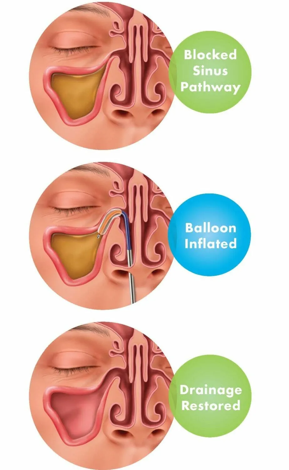 Balloon Sinuplasty