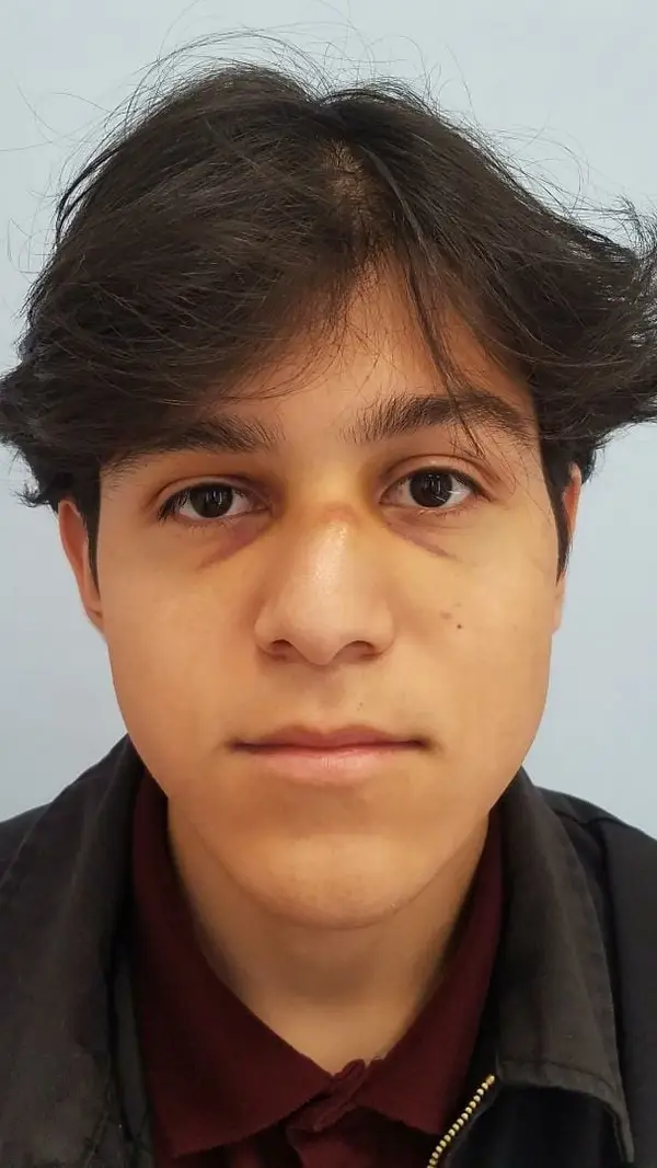 Rhinoplasty — before photo, front view, Dr. Faramarz Shabdiz, MD, Orange County, CA. Individual results vary.