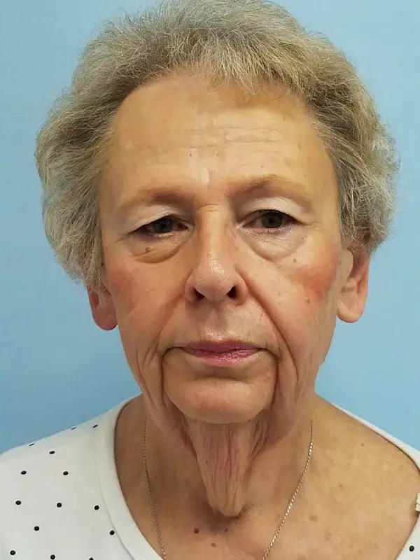 Rhinoplasty — result photo, front view, Dr. Faramarz Shabdiz, MD, Orange County, CA. Individual results vary.