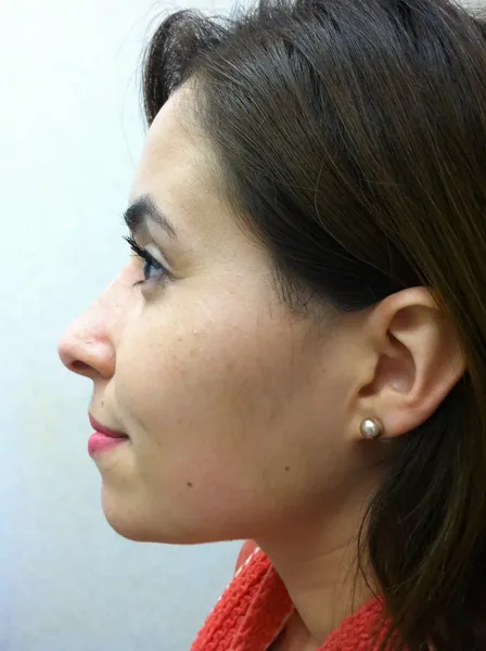 Additional Results — result photo, Dr. Faramarz Shabdiz, MD, Orange County, CA. Individual results vary.