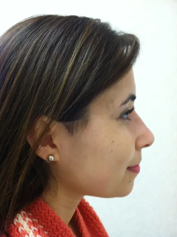 Rhinoplasty — result photo, Dr. Faramarz Shabdiz, MD, Orange County, CA. Individual results vary.