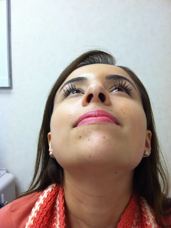 Rhinoplasty — after — Dr. Faramarz Shabdiz, MD. Individual results vary.