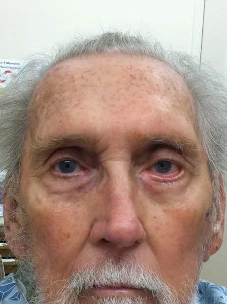 Facial reconstruction — before — Dr. Faramarz Shabdiz, MD. Individual results vary.