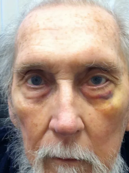 Facial reconstruction — after — Dr. Faramarz Shabdiz, MD. Individual results vary.