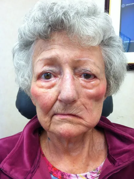 Facial Tumor & Reconstruction — result photo, Dr. Faramarz Shabdiz, MD, Orange County, CA. Individual results vary.