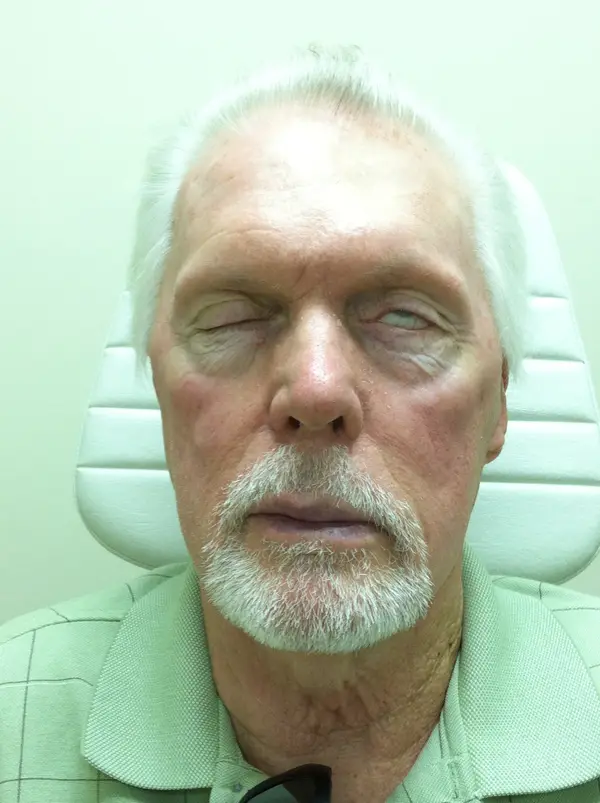 Facial Tumor & Reconstruction — result photo, Dr. Faramarz Shabdiz, MD, Orange County, CA. Individual results vary.
