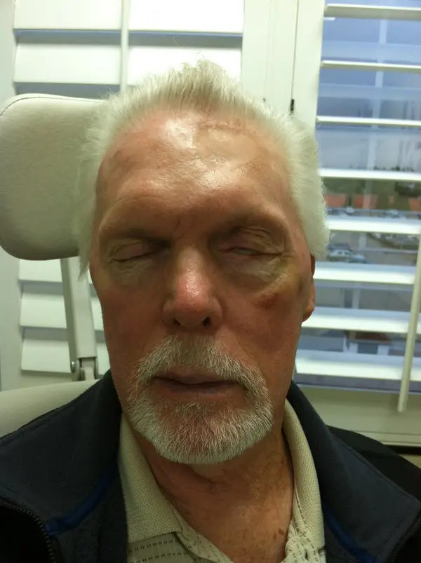 Facial Tumor & Reconstruction — result photo, Dr. Faramarz Shabdiz, MD, Orange County, CA. Individual results vary.