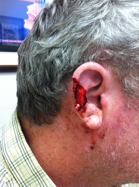 Facial reconstruction — before — Dr. Faramarz Shabdiz, MD. Individual results vary.