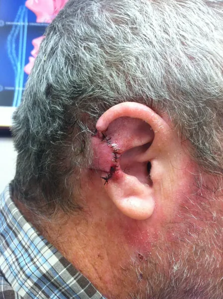 Facial Tumor & Reconstruction — result photo, Dr. Faramarz Shabdiz, MD, Orange County, CA. Individual results vary.