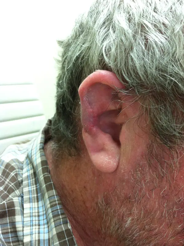 Facial Tumor & Reconstruction — result photo, Dr. Faramarz Shabdiz, MD, Orange County, CA. Individual results vary.