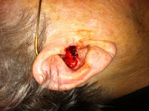 Facial reconstruction — before — Dr. Faramarz Shabdiz, MD. Individual results vary.