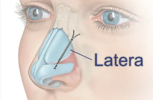 Nasal Valve Repair & Latera