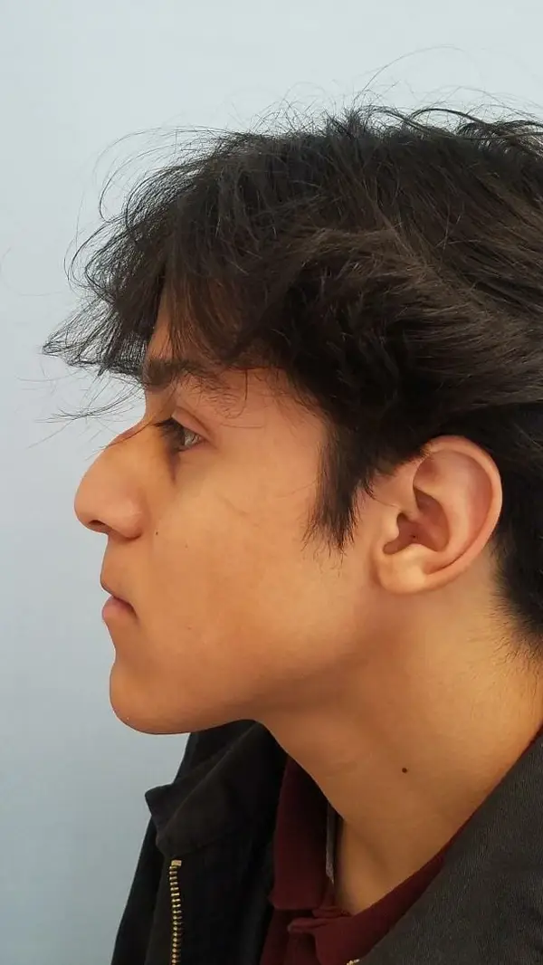 Rhinoplasty — before, left profile — Dr. Faramarz Shabdiz, MD. Individual results vary.