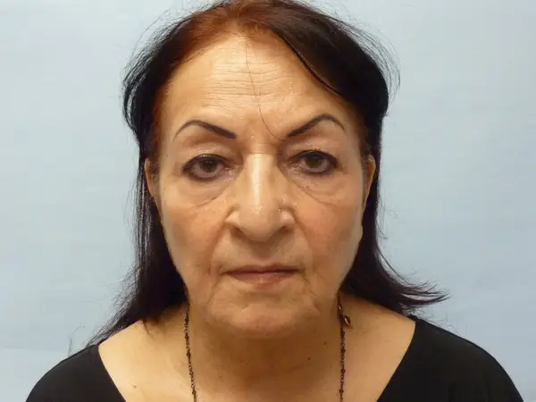 Rhinoplasty — before — Dr. Faramarz Shabdiz, MD. Individual results vary.