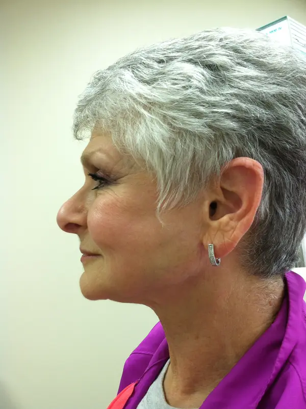 Rhinoplasty — before — Dr. Faramarz Shabdiz, MD. Individual results vary.