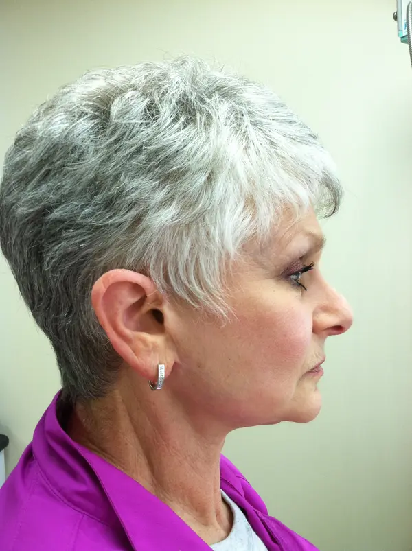 Rhinoplasty — before — Dr. Faramarz Shabdiz, MD. Individual results vary.
