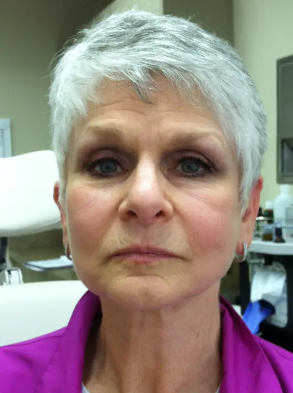 Rhinoplasty — before — Dr. Faramarz Shabdiz, MD. Individual results vary.