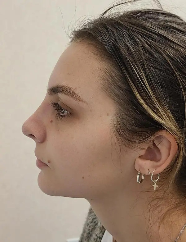 Rhinoplasty — after, left profile — Dr. Faramarz Shabdiz, MD. Individual results vary.