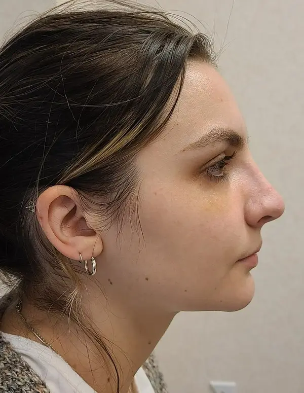Rhinoplasty — after, right profile — Dr. Faramarz Shabdiz, MD. Individual results vary.