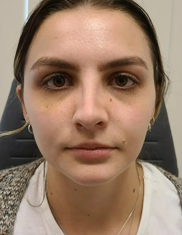 Rhinoplasty — after, front — Dr. Faramarz Shabdiz, MD. Individual results vary.
