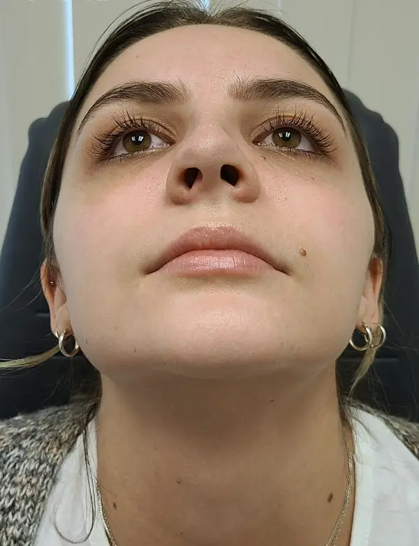 Rhinoplasty — result photo, base view, Dr. Faramarz Shabdiz, MD, Orange County, CA. Individual results vary.