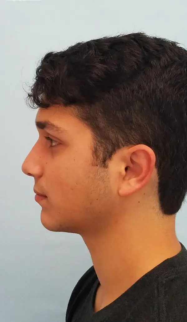 Rhinoplasty — after, left profile — Dr. Faramarz Shabdiz, MD. Individual results vary.