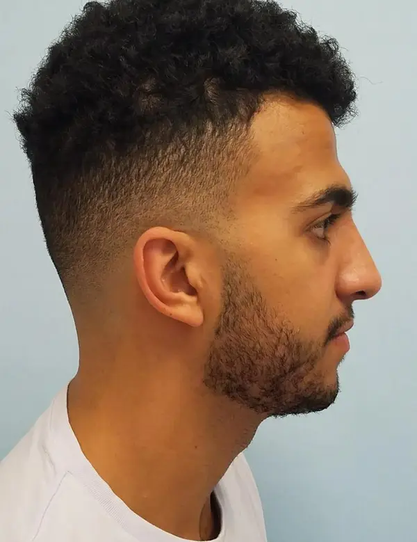 Rhinoplasty — after, right profile — Dr. Faramarz Shabdiz, MD. Individual results vary.