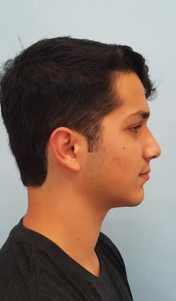Rhinoplasty — after, right profile — Dr. Faramarz Shabdiz, MD. Individual results vary.