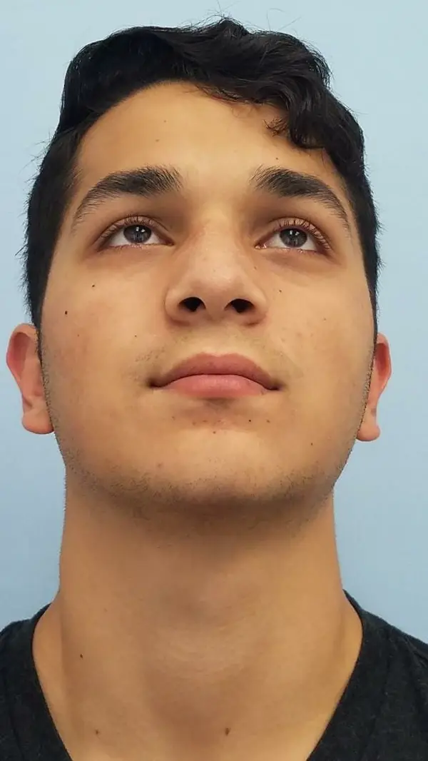Rhinoplasty — result photo, base view, Dr. Faramarz Shabdiz, MD, Orange County, CA. Individual results vary.